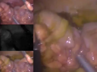 Avoidance of Ischemia at Proximal Colonic Transection during TME using Near-infrared Fluorescence Avoidance of Ischemia at Proximal Colonic Transection during TME using Near-infrared Fluorescence