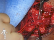 Axillary Artery to Vein AV Graft for Dialysis Access Axillary Artery to Vein AV Graft for Dialysis Access