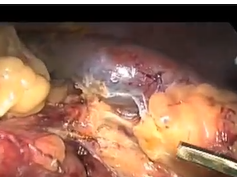 Bad Video - Laparoscopic Distal Pancreatectomy Complicated By Renal Injury