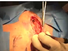 Barbed Sutures for Mohs Surgery