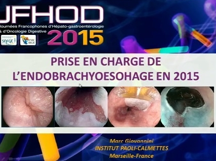 Barrett dysplasique : place respective de la radiofréquence et de la résection endoscopique Barrett dysplasique : place respective de la radiofréquence et de la résection endoscopique