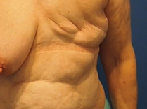 Be Happy- Spare the Nipples: Plastic Surgery Hot Topics