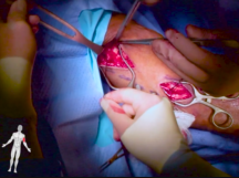 Below Knee Amputation Below Knee Amputation