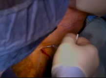 Below Knee Guillotine Amputation Below Knee Guillotine Amputation