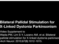 Bilateral Pallidal Stimulation for X-Linked Dystonia Parkinsonism Part 1 Bilateral Pallidal Stimulation for X-Linked Dystonia Parkinsonism Part 1