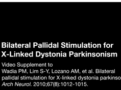 Bilateral Pallidal Stimulation for X-Linked Dystonia Parkinsonism Part 2 Bilateral Pallidal Stimulation for X-Linked Dystonia Parkinsonism Part 2