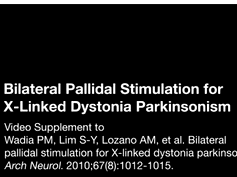 Bilateral Pallidal Stimulation for X-Linked Dystonia Parkinsonism Part 3 Bilateral Pallidal Stimulation for X-Linked Dystonia Parkinsonism Part 3