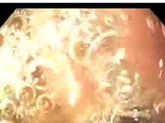 Bile Reflux Gastritis - 2