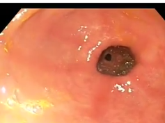 Bile Reflux Gastritis