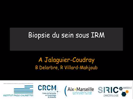 Biopsie du sein sous IRM Biopsie du sein sous IRM