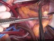Biventricular fibroma resection in an adult