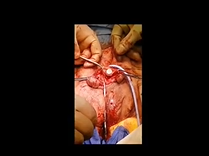 Bladder Extrophy Radial Artery Phalloplasty Extrophy Related Issues