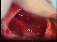 Bleeding nasal wall
