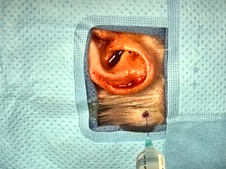 Bone anchored hearing aid (BAHA) surgery