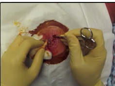breast abscess video - POV drainage procedure