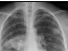 Breast Cancer - Chest x-ray - Metastases Breast Cancer - Chest x-ray - Metastases