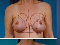 Breast Reconstruction in a DayPlastic Surgery Hot Topics with Rod J. Rohrich, MD Breast Reconstruction in a DayPlastic Surgery Hot Topics with Rod J. Rohrich, MD