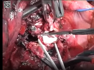Bronchial and pulmonary arterial sleeve resection Bronchial and pulmonary arterial sleeve resection