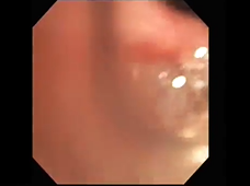 Bronchial Thermoplasty