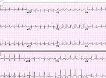 Brugada syndrome ECG and overview
