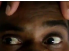 Bruns Nystagmus and Contrast-Enhanced Computed Tomography of the Brain Bruns Nystagmus and Contrast-Enhanced Computed Tomography of the Brain