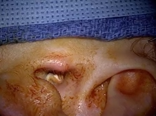 Butterfly graft tympanolasty