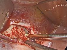 Caldwell-Luc Procedure for Maxillary Sinus Schwannoma