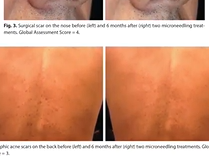 Can Microneedling Improve Scars? Plastic Surgery Hot Topics with Rod J. Rohrich, MD Can Microneedling Improve Scars? Plastic Surgery Hot Topics with Rod J. Rohrich, MD