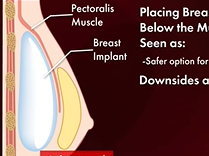 Can more women have Pre-Pec Breast Reconstruction? Plastic Surgery Hot Topics with Rod Rohrich, MD Can more women have Pre-Pec Breast Reconstruction? Plastic Surgery Hot Topics with Rod Rohrich, MD