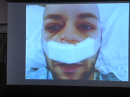 Canadian Acromegaly Conference 2017: Santino Matrundola