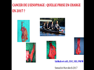 Cancer de l'oesophage : quelle prise en charge en 2017 ?