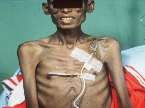 Cancer Related Cachexia