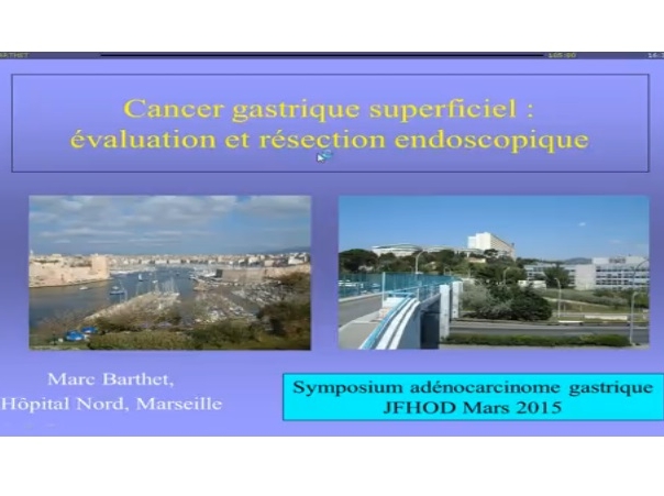 Cancer superficiel de l’estomac