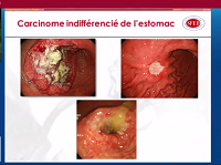 Carcinome indifférencié sur une biopsie : que faire ?