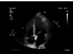 Cardiac Ultrasonogram Showing Apical 4 Chamber View