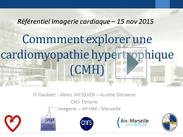 Cardiomyopathie non Ischémique ; CMH et CMD