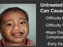Caring for Clefts Around the World. Plastic Surgery Hot Topics with Rod J. Rohrich, MD Caring for Clefts Around the World. Plastic Surgery Hot Topics with Rod J. Rohrich, MD