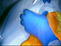 Carotid Body Tumor Excision Carotid Body Tumor Excision