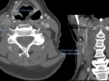 Carotid Bypass after Failure of Temporary Balloon Occlusion Carotid Bypass after Failure of Temporary Balloon Occlusion