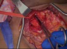 Carotid-Carotid Subclavian Bypass Carotid-Carotid Subclavian Bypass