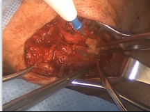 Carotid Endarterectomy (CEA) Part 1 Carotid Endarterectomy (CEA) Part 1