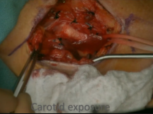 Carotid Endarterectomy - CEA Carotid Endarterectomy - CEA