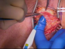 Carotid Subclavian Bypass with TEVAR Carotid Subclavian Bypass with TEVAR