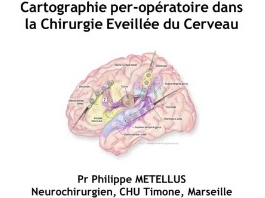 Cartographie cérébrale (2/3) - Condition éveillée : le per-opératoire