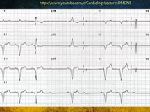 Case based ECG discussion on Bradyarrythmia Dr Atul Abhyankar