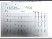 Case Discussion Multivalvular Heart Disease with IE 16th Cardiology Update 2020 Case Discussion Multivalvular Heart Disease with IE 16th Cardiology Update 2020