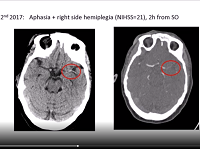 Case presentation: Cardiac complication on the stroke unit