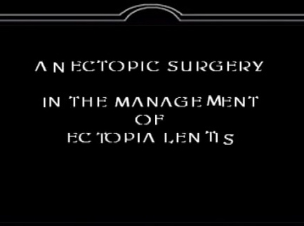 Cataract - An Ectopic Surgery in the Management of Ectopia Lentis