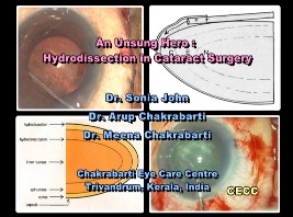 Cataracte - Une solution méconnue - Hydrodissection en chirurgie de la cataracte Cataracte - Une solution méconnue - Hydrodissection en chirurgie de la cataracte