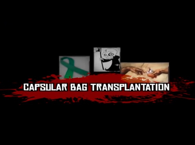 Cataract - Capsular Bag Transplantation